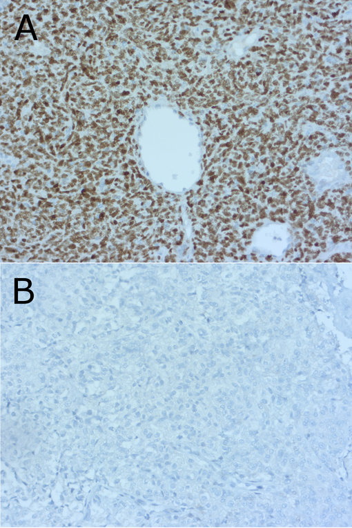 nuclear STAT6 in hemangiopericytoma