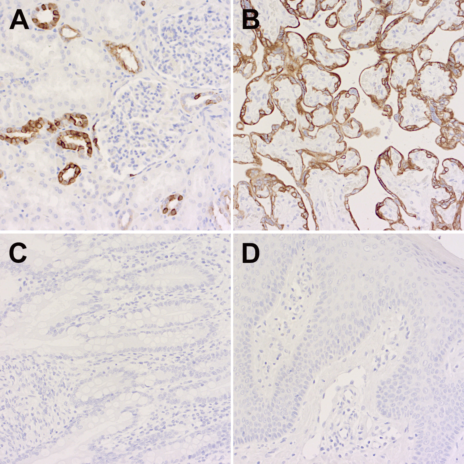 Ck7+ ck20+ tumors