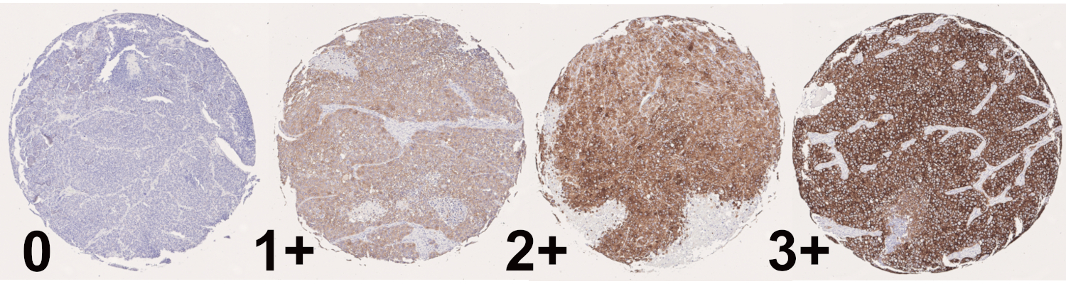 Classification of CK7 status in lung PDX from 0 (negative) to 3+ (very strong expression). 