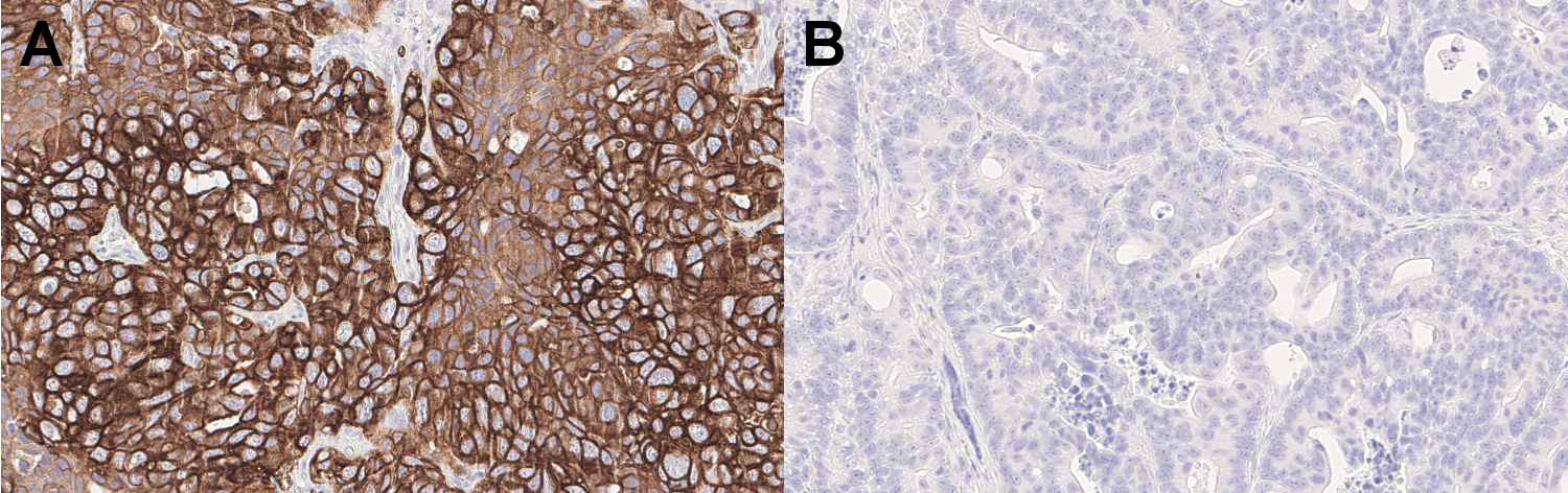 Immunohistochemical staining of formalin fixed paraffin embedded sections of A: a CK7-positive human pancreatic adenocarcinoma and B: a CK7-negative human colon carcinoma