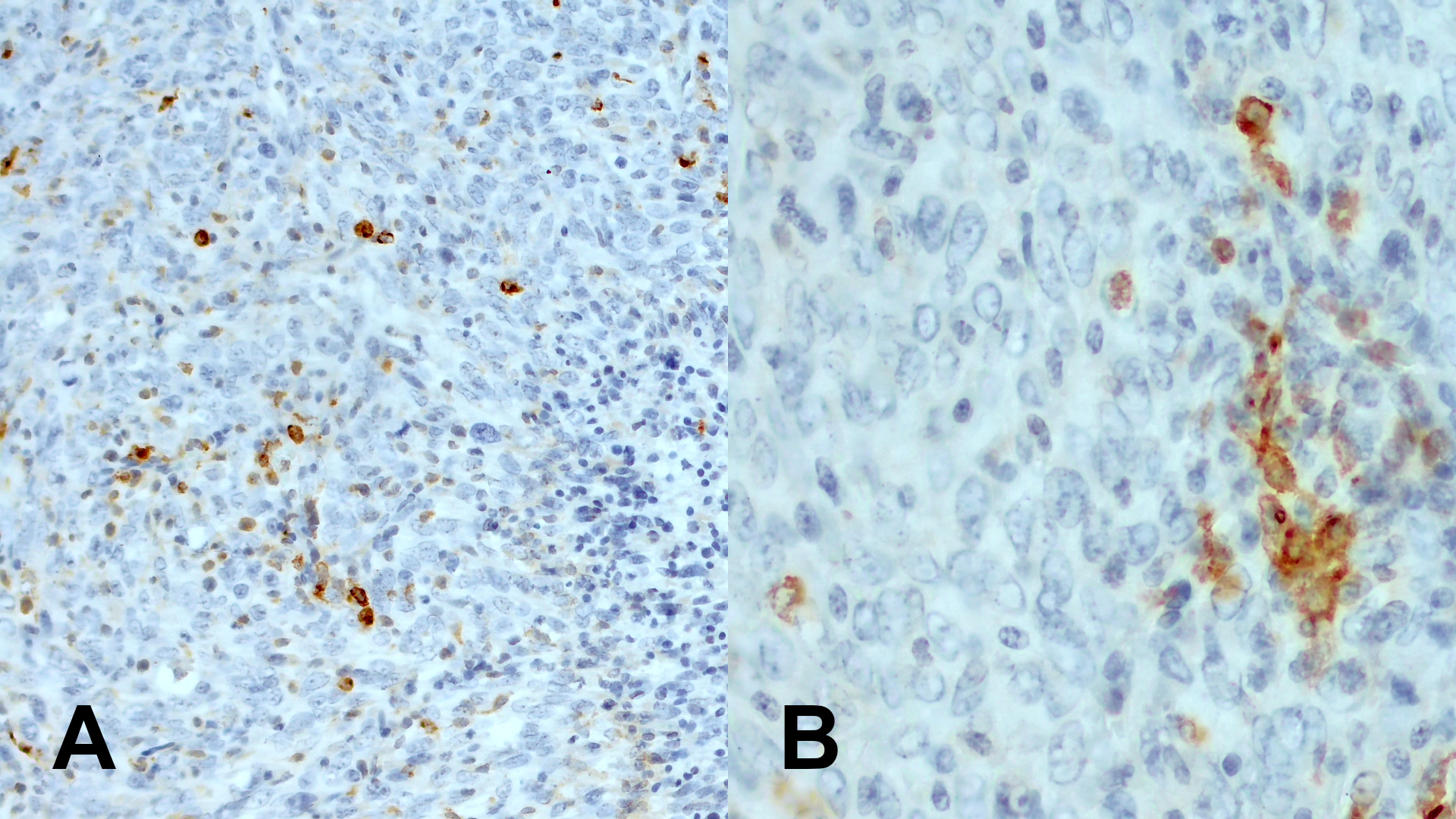Immunohistochemical staining for CD11c in formalin-fixed paraffin embedded sections of a murine breast cancer