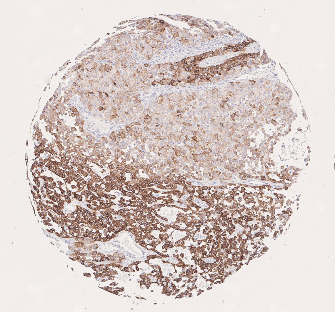 CK7 immunohistochemistry visualizes tumor heterogeneity in NSCLC adenocarcinoma subtype in a brownish color