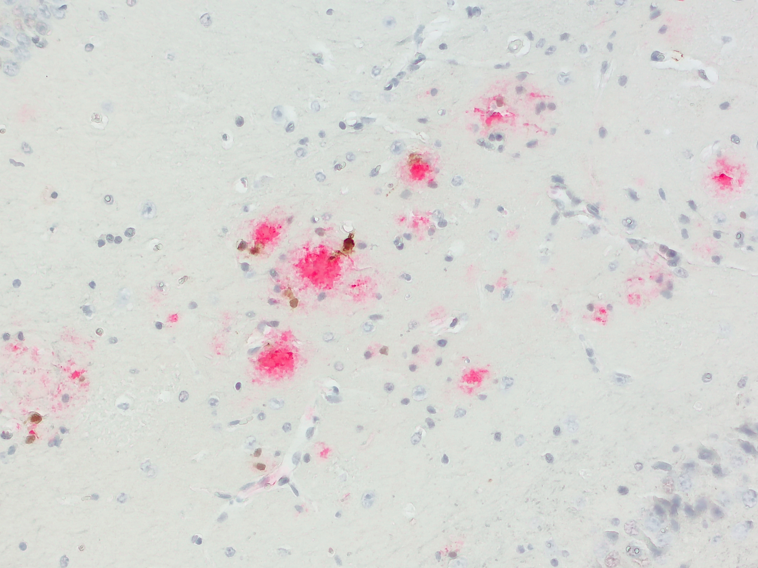  Chromogenic double-staining of Galectin-3 (brown) and Abeta (AP-RED; red) in a mouse model of Alzheimer’s disease