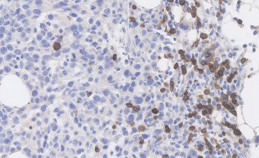 Infiltration of CD3e positive cells in murine breast tumor