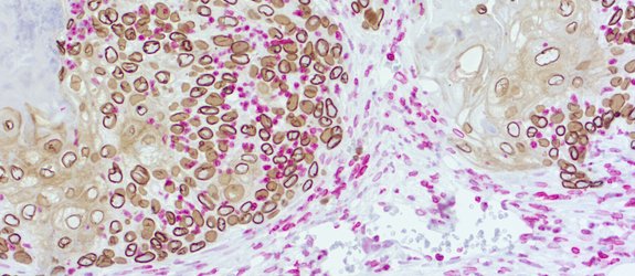 Immunohistochemical doublestaining of patient-derived lung cancer model