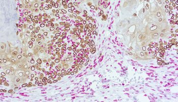 Immunohistochemical doublestaining of patient-derived lung cancer model