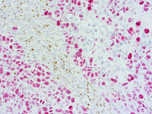 Immunohistochemical doublestaining of patient-derived pancreas cancer model
