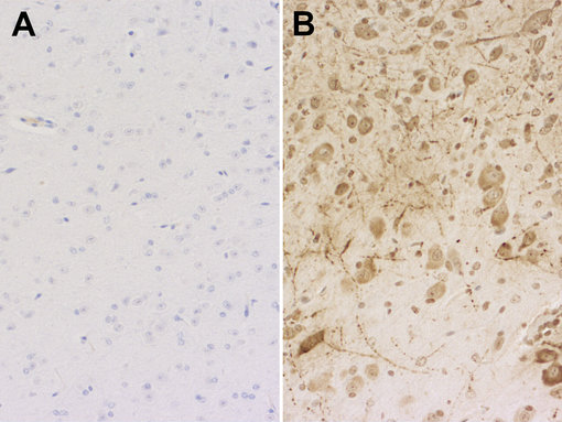 Immunohistochemical staining of formalin fixed paraffin embedded brain sections from K18-hACE2 transgenic mice B: infected with SARS-CoV-2 or A: non-infected control using the monoclonal anti-Sars-Cov-2 nucleocapsid antibody clone #53E2 (cat. no. HS-452 111, dilution 1:1000; DAB). Nuclei have been counterstained with haematoxylin (blue).