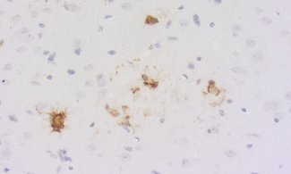 Neuroinflammation is the biological response of the central nervous system (CNS) to harmful stimuli.